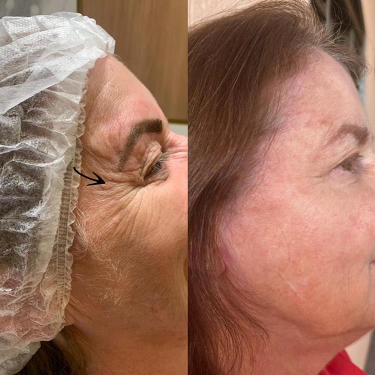 botox-antes-e-depois03