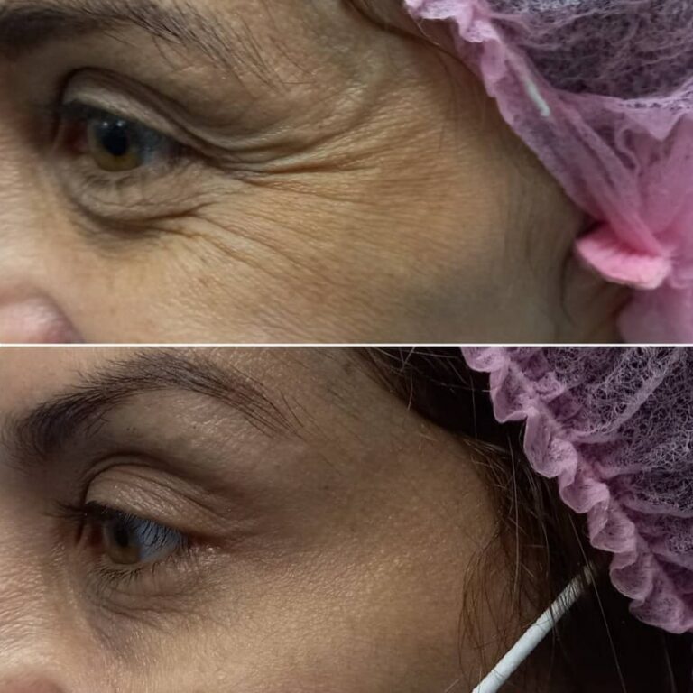 botox-antes-e-depois11-768x768