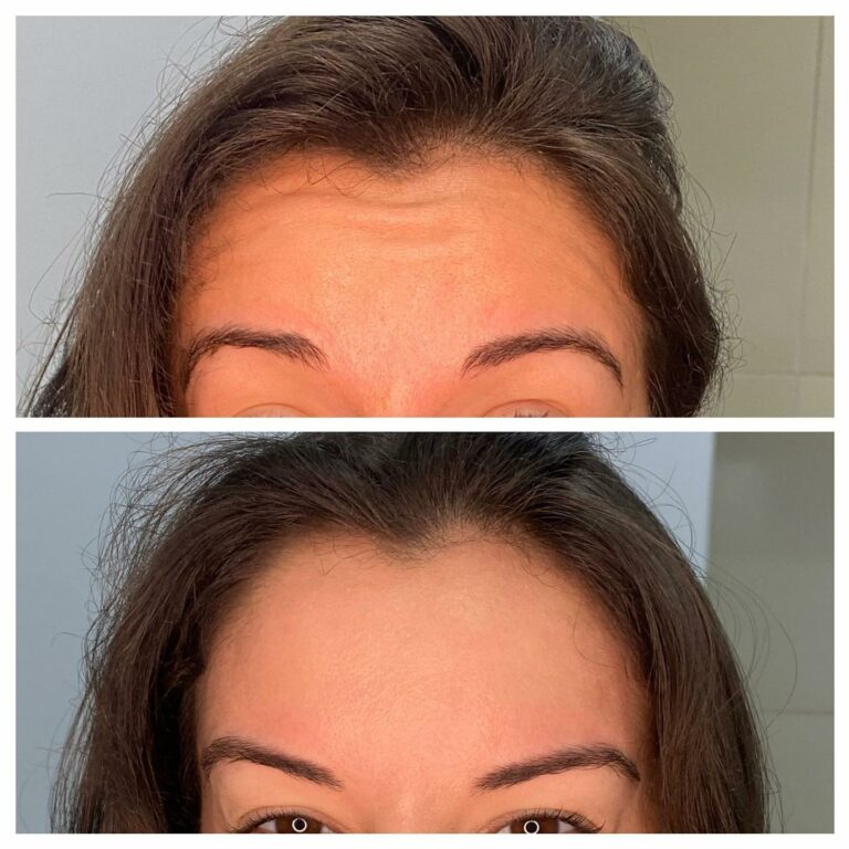 botox-antes-e-depois12-768x768