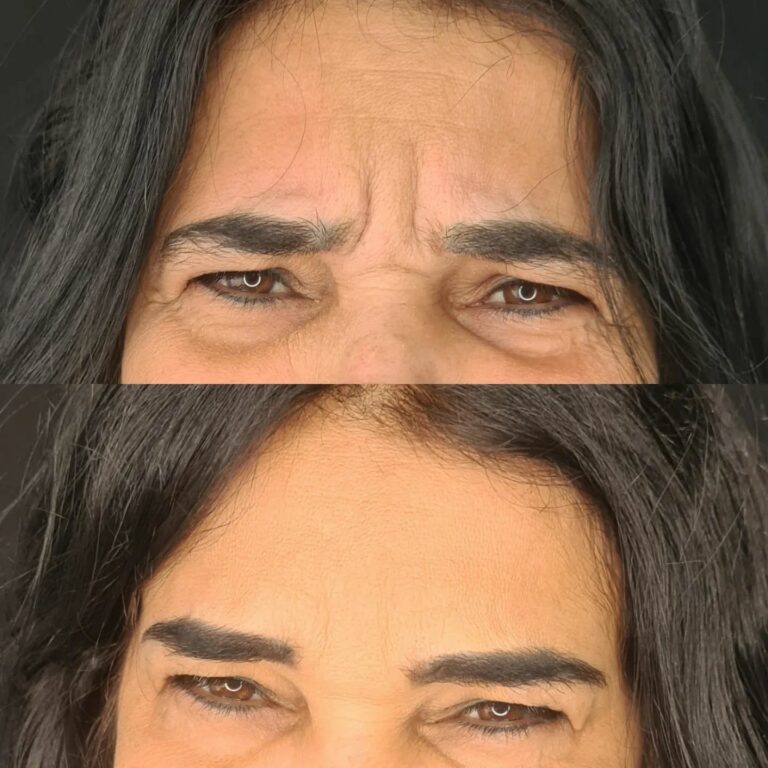 botox-antes-e-depois18-768x768